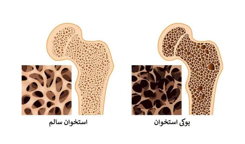 پوکی استخوان بیماری خاموش
